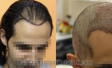 Hair restoration procedure before and after pictures