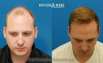 Hair transplantation surgery before and after pictures