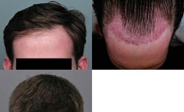 Hair transplantation surgery before and after photos