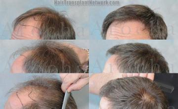 Hair restoration procedure results