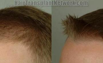 Hair restoration procedure before and after pictures