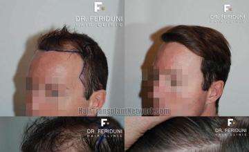 Hair transplantation surgery before and after photos