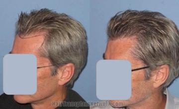 Hair restoration procedure before and after pictures