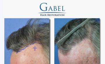 Hair restoration procedure before and after photos