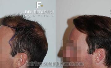 Hair transplantation surgical procedure before and after images