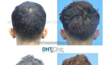 Surgical hair transplantation result photographs