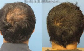 Back view - Before and after hair replacement surgery