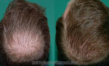 Hair restoration procedure before and after photos