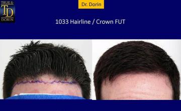 Hair transplantation surgery before and after photos