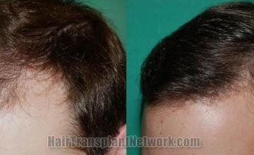 Hair restoration procedure results