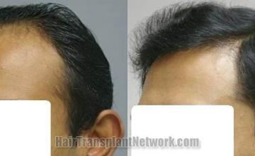 Left view before and after hair replacement results