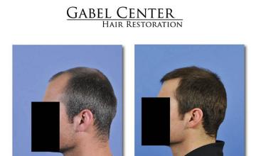 Hair transplantation surgery before and after photos