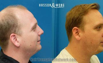 Hair restoration procedure before and after results