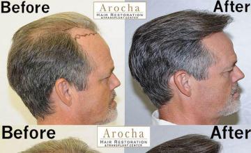 Hair transplantation surgery before and after photos