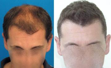 Top view - Before and after surgical hair replacement