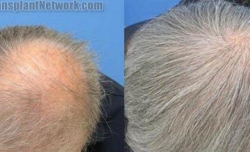 Before and after photos of  hair restoration to the crown