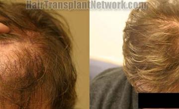 Hair transplantation surgery before and after images