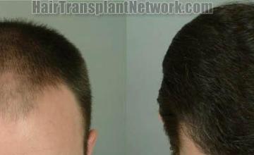 Hair restoration procedure before and after pictures