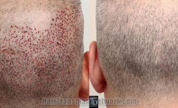 Hair restoration procedure before and after pictures