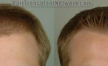 Hair transplantation surgery before and after images