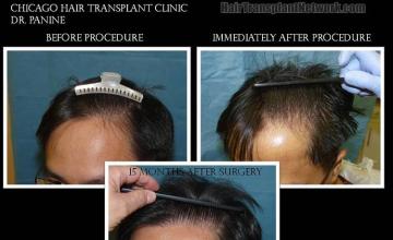 Before and after hair restoration photographs