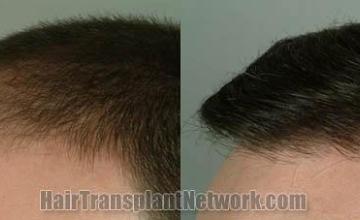 Hair transplantation surgery before and after images