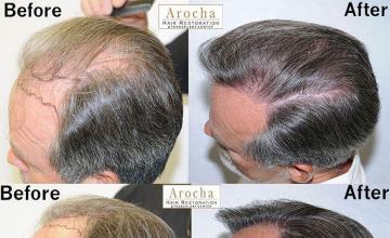 Hair transplantation surgery before and after images