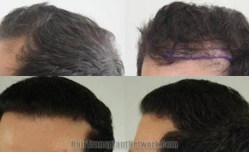 Hair transplantation surgery before and after pictures