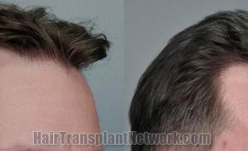 Hair transplantation surgery before and after photos