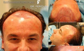 Hair transplant procedure intraoperative photos