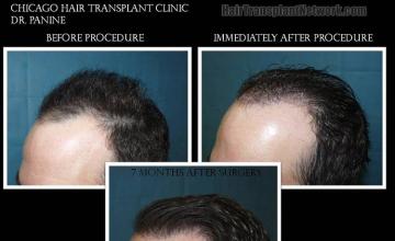 Photos showing hair restoration procedure results