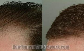 Hair transplantation surgery before and after images