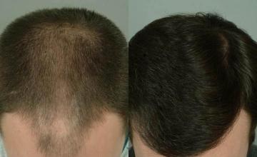 Hair transplantation surgery before and after photos