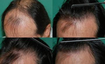 Before and after surgical hair restoration images