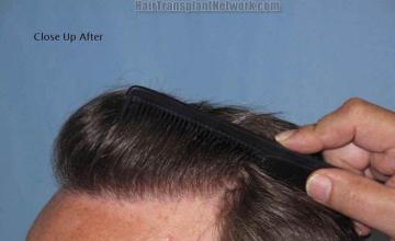 Hair restoration surgery before and after images