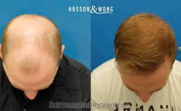 Top view before and after hair restoration results