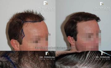 Hair transplantation surgery before and after images