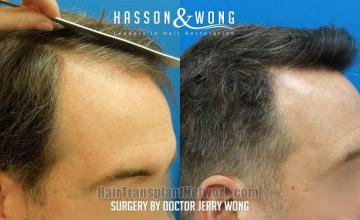 Hair restoration procedure before and after result images