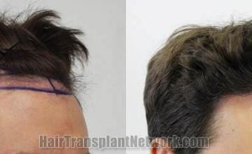 Hair transplantation surgery before and after pictures