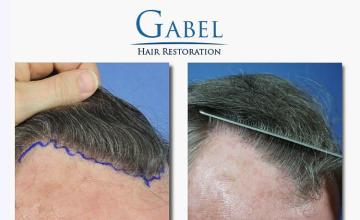 Hair restoration procedure before and after images