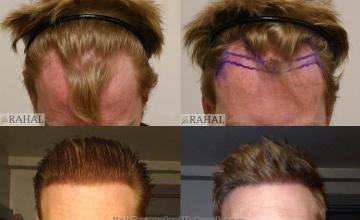 Top view before and after hair restoration results