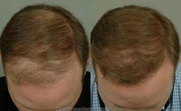 Hair transplantation surgery before and after photos