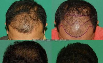 Top view before and after hair restoration results