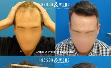 Before and after hair restoration procedure images