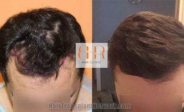 Hair transplantation surgery before and after images