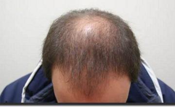 Hair restoration procedure results