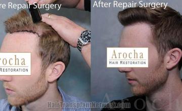 Hair transplantation surgery before and after images