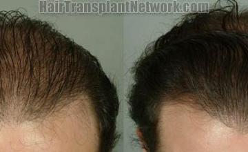 Hair transplantation surgery before and after images