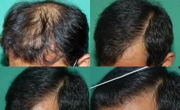 Hair restoration procedure before and after results