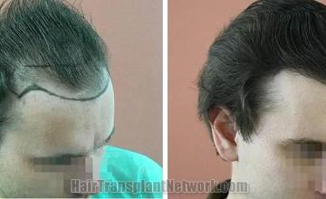 Hair restoration procedure before and after pictures